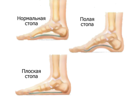 Паталогии стоп у детей