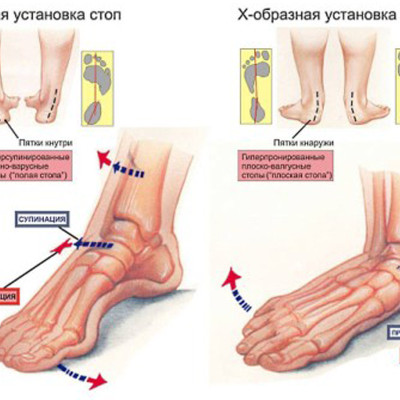 Плоскостопие