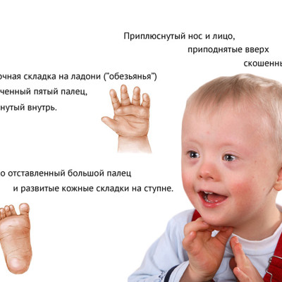 Синдром Дауна