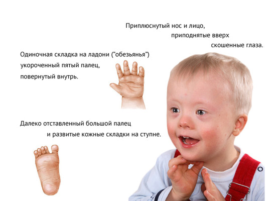 Синдром Дауна