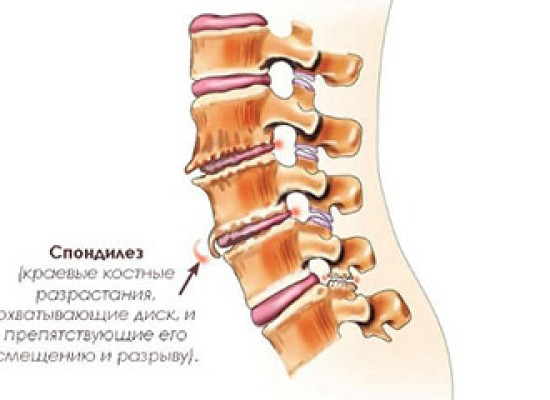 Комбинированный спондилез при травматических повреждениях позвоночника