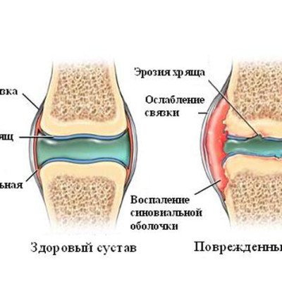 Сыворотка крови и синовиальная жидкости при артритах