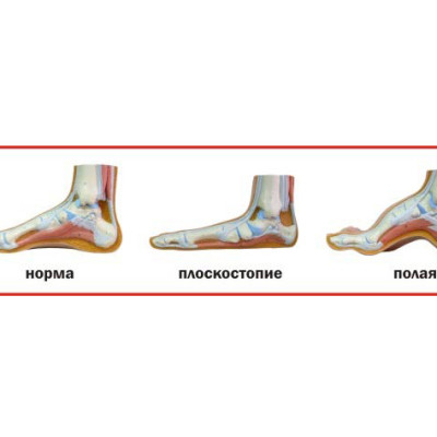 Педобарографическая диагностика плоскостопия у детей