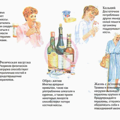Факторы риска остеопороза и их профилактика и лечение
