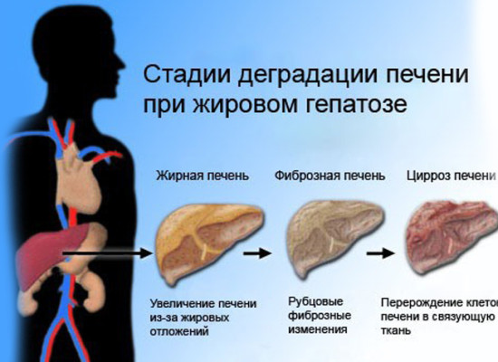 Гепатоз