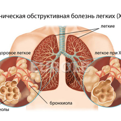 Хронические обструктивные болезни легких (ХОБЛ)