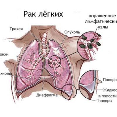 Класификация опухолей и лечение кинезитерапией
