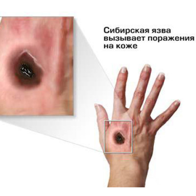 Сибирская язва