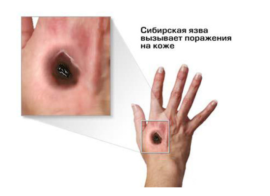 Сибирская язва