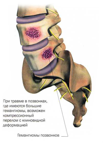 Гемангиома