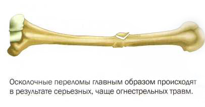 oskolochniy-perelom