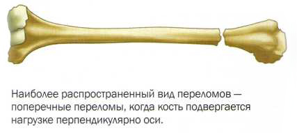 poperechniy-perelom