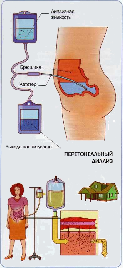 Перитонеальный диалез