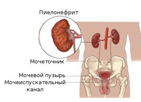 Лечение пиелонефрита