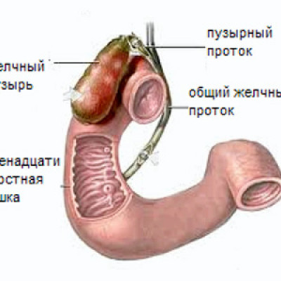 Желчные свищи