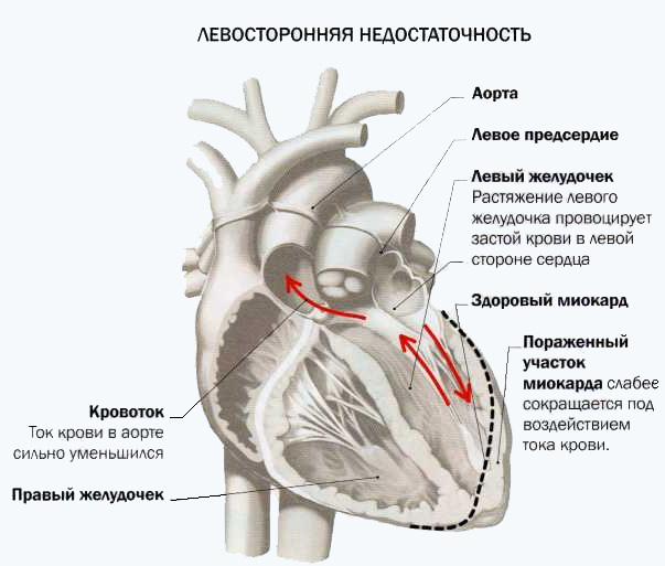Левосторонняя сердечная недостаточность