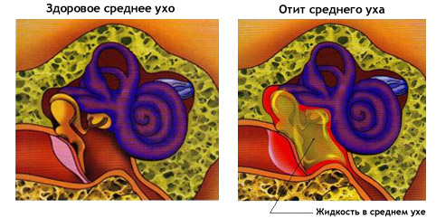 Средний отит (воспаление среднего уха)