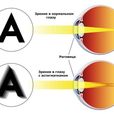 Астигматизм