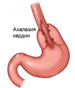 Ахалазия кардиального отдела пищевода