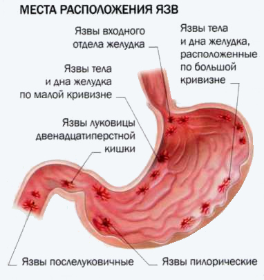 Язвенная болезнь желудка и двенадцатиперстной кишки