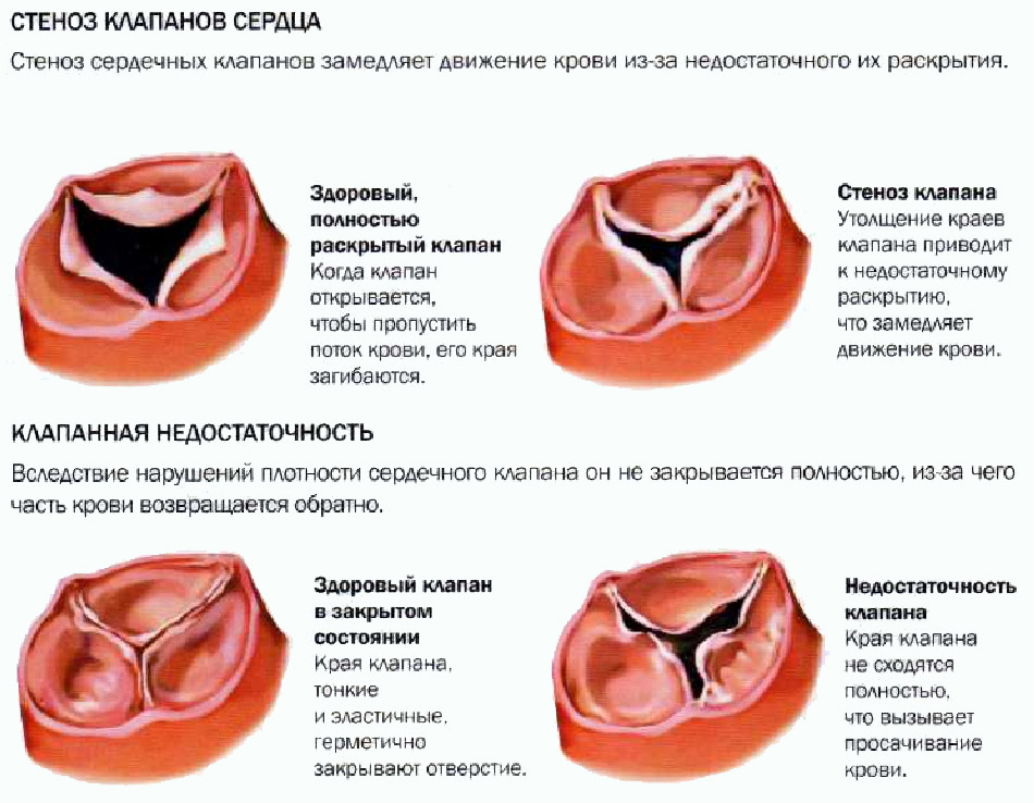 Пороки сердечных клапанов