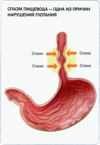 Спазм пищевода