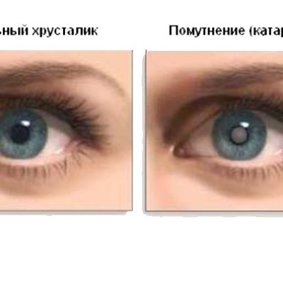 Катаракта