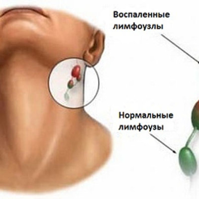 Дифтерия. Заболевания, вызываемые бактериями