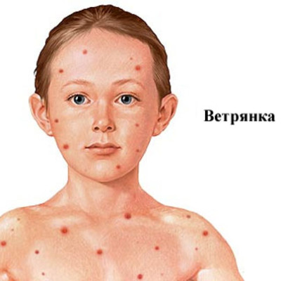 Ветрянка