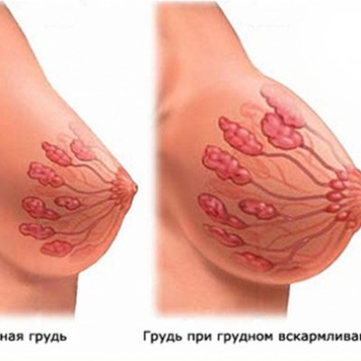 Мастит. Заболевание молочной железы