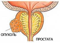 opuhol-prostata